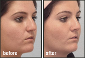 Rhinoplasty Before and After Photos